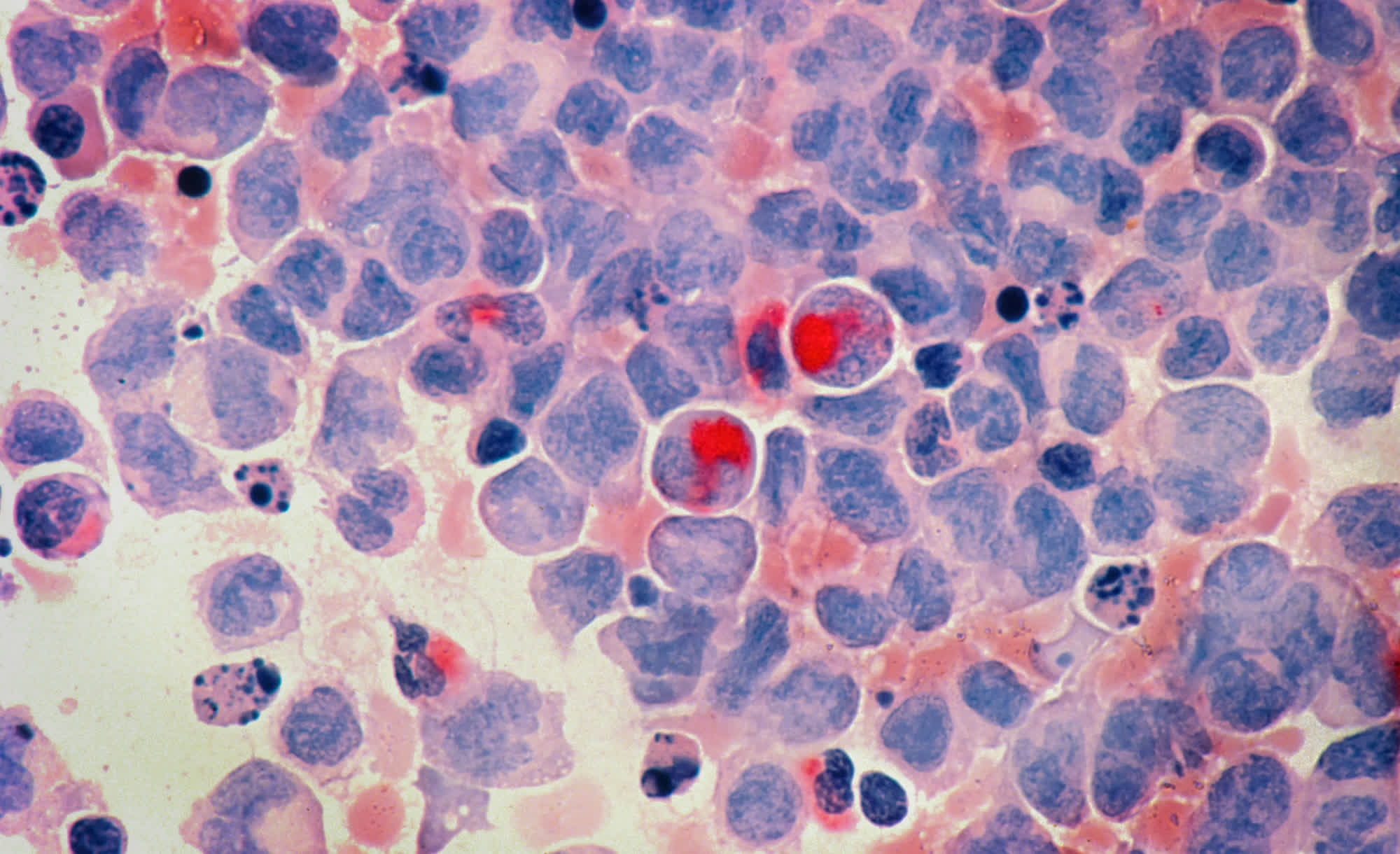 googlein yapay zekasi kanser konusunda onemli bir kesif yapti Q9qzjmPR.jpg